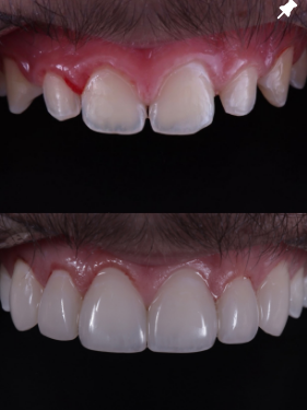 Comparação de dois registros de um sorriso — fotografia 1