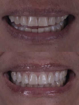 Comparação de dois registros de um sorriso — fotografia 3